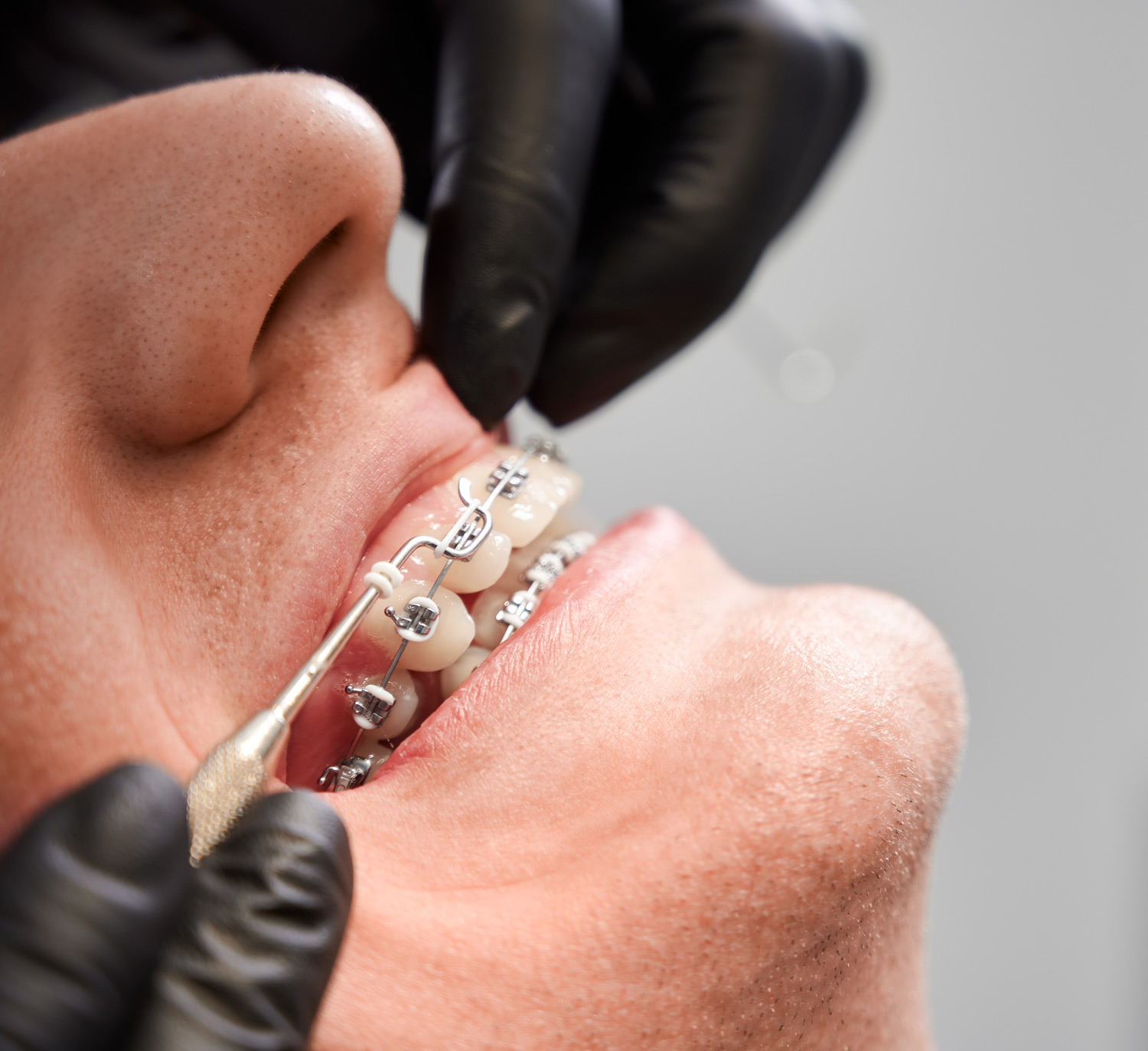 CabinetWhite Orthodontie Bagues